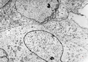 F,49y. | rhabdomyosarcoma - pankreas F,49y. | rhabdomyosarcoma - pankreas